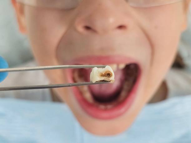 Best Emergency Root Canal Therapy in Bangor Base, WA